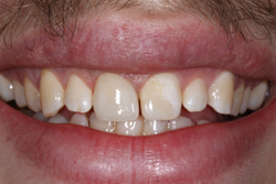 Dental Crown Work Dental Crown Work