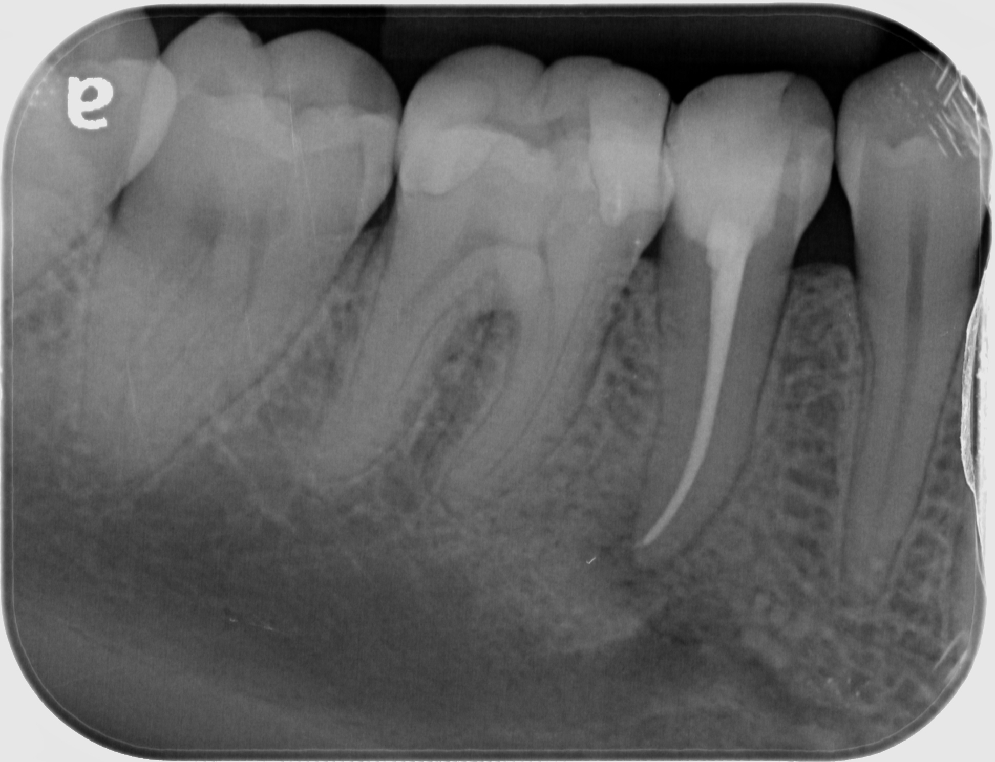 Root Canal St Kilda Dentist