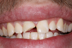 Tooth Fracture Tooth Fracture
